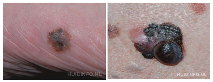 Melanoom | huidinfo.nl | informatiefolder van de dermatoloog