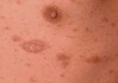 Pityriasis rosea | huidinfo.nl - uitleg van de dermatoloog