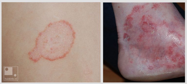 Schimmelinfectie Huidinfo Nl Informatie Van De Dermatoloog Over