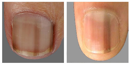 Donkere verkleuring van de nagel | huidinfo.nl - uitleg van de dermatoloog