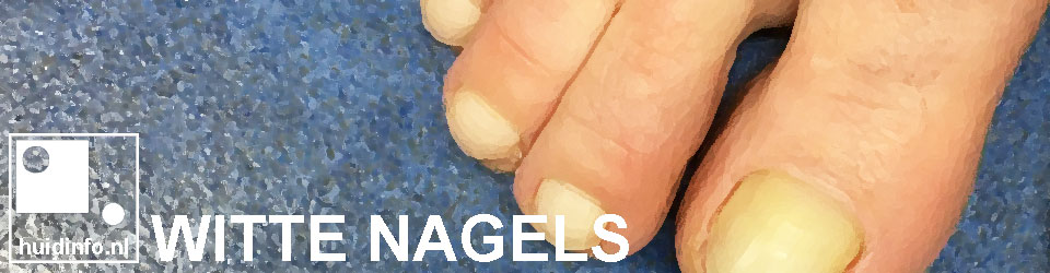 Witte nagels | huidinfo.nl - van de dermatoloog